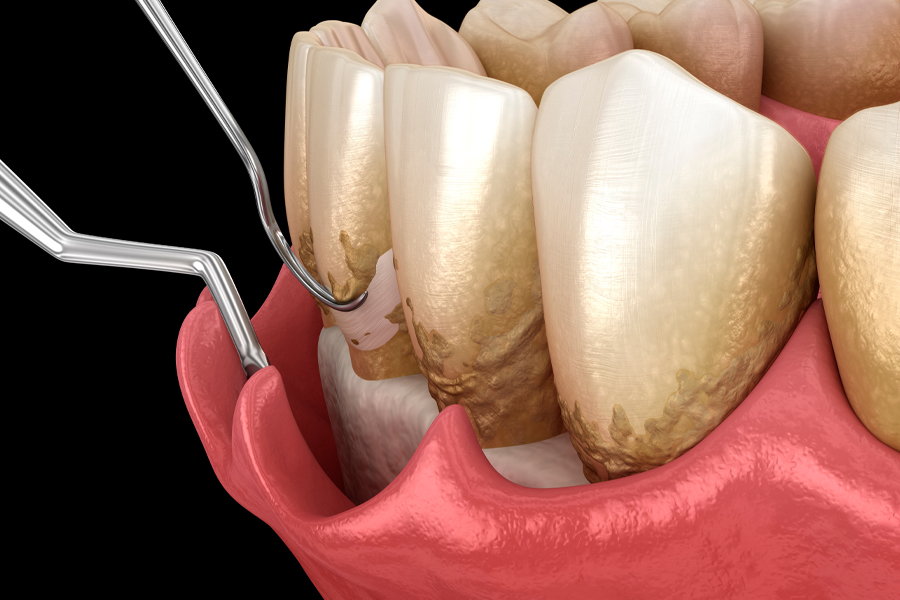 歯周外科